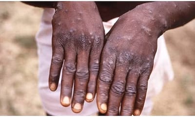 Monkeypox: Ghana Records 5 Cases In 3 Regions