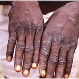 Monkeypox: Ghana Records 5 Cases In 3 Regions